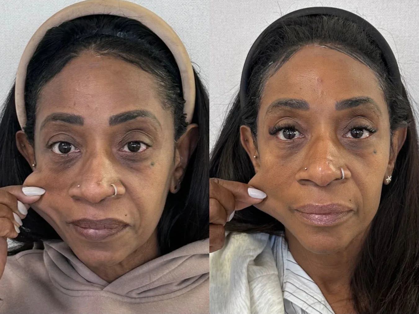 Sulco nasogeniano, antes e depois