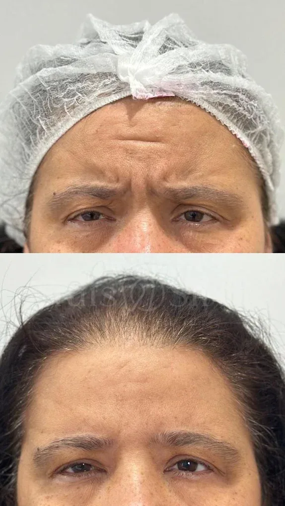 Região da glabela, antes e depois
