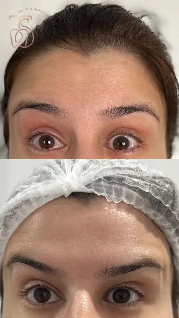 Expressão suavizada, antes e depois