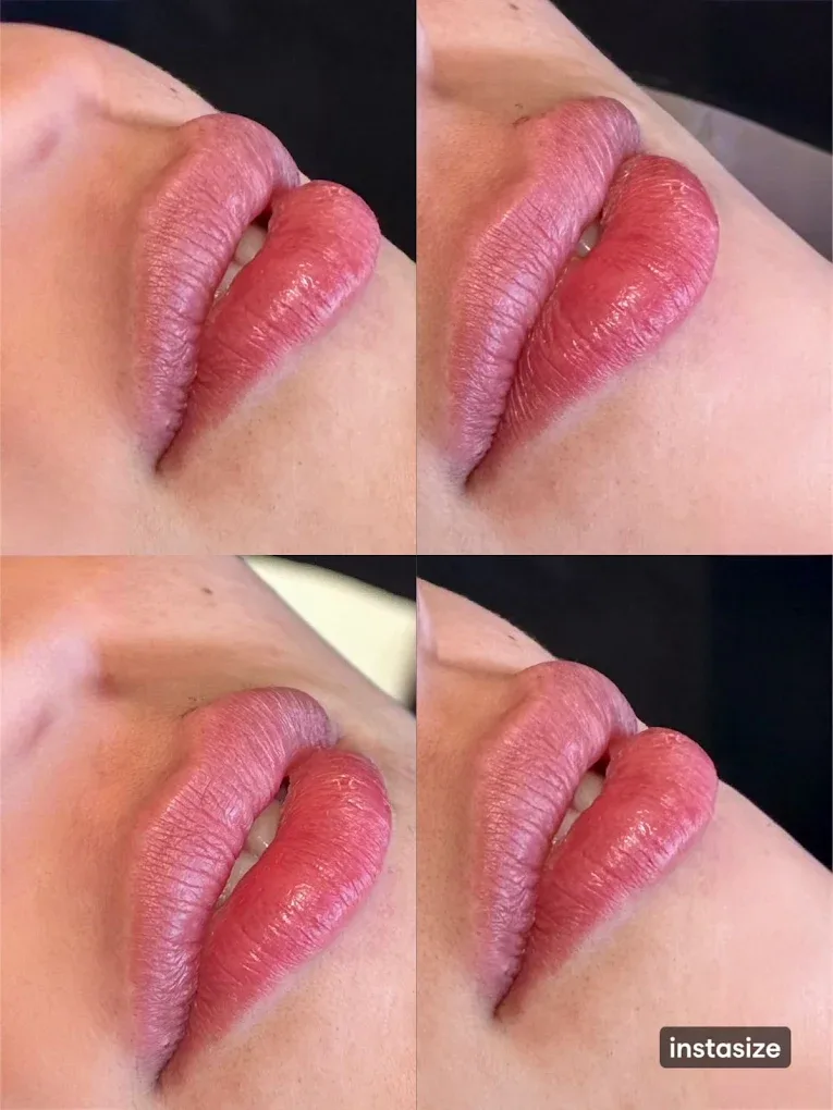 Preenchimento labial