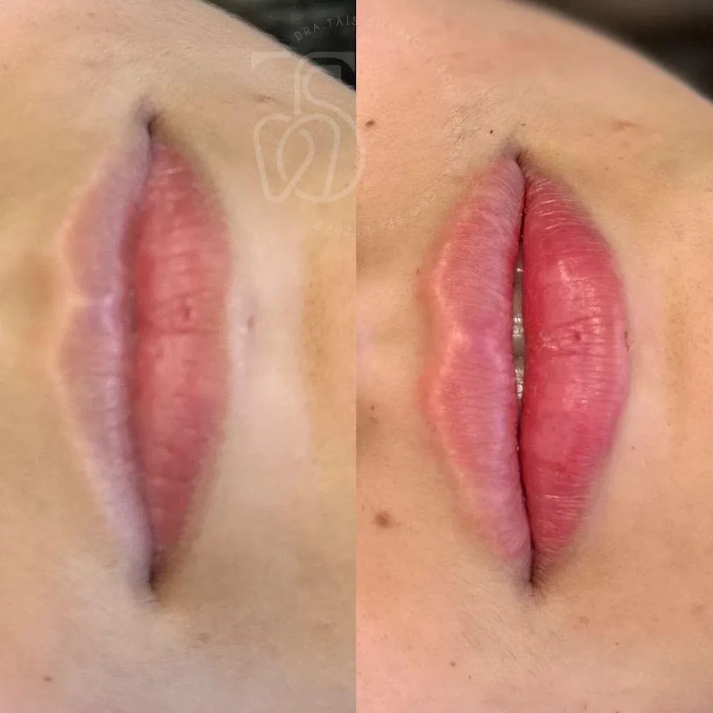 Preenchimento labial