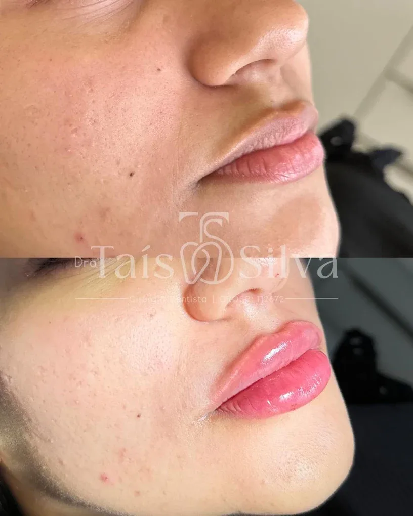 Hidratação e projeção, antes e depois