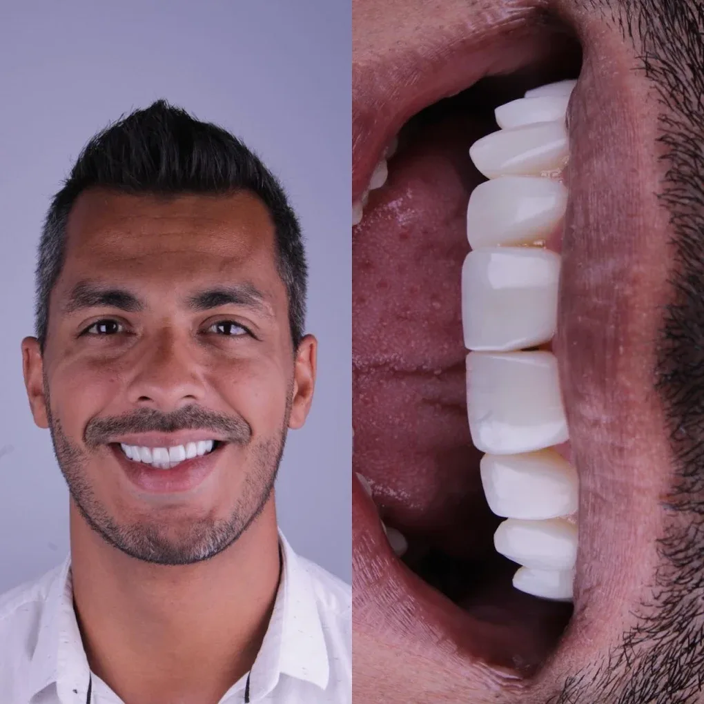 Lentes de contato dental