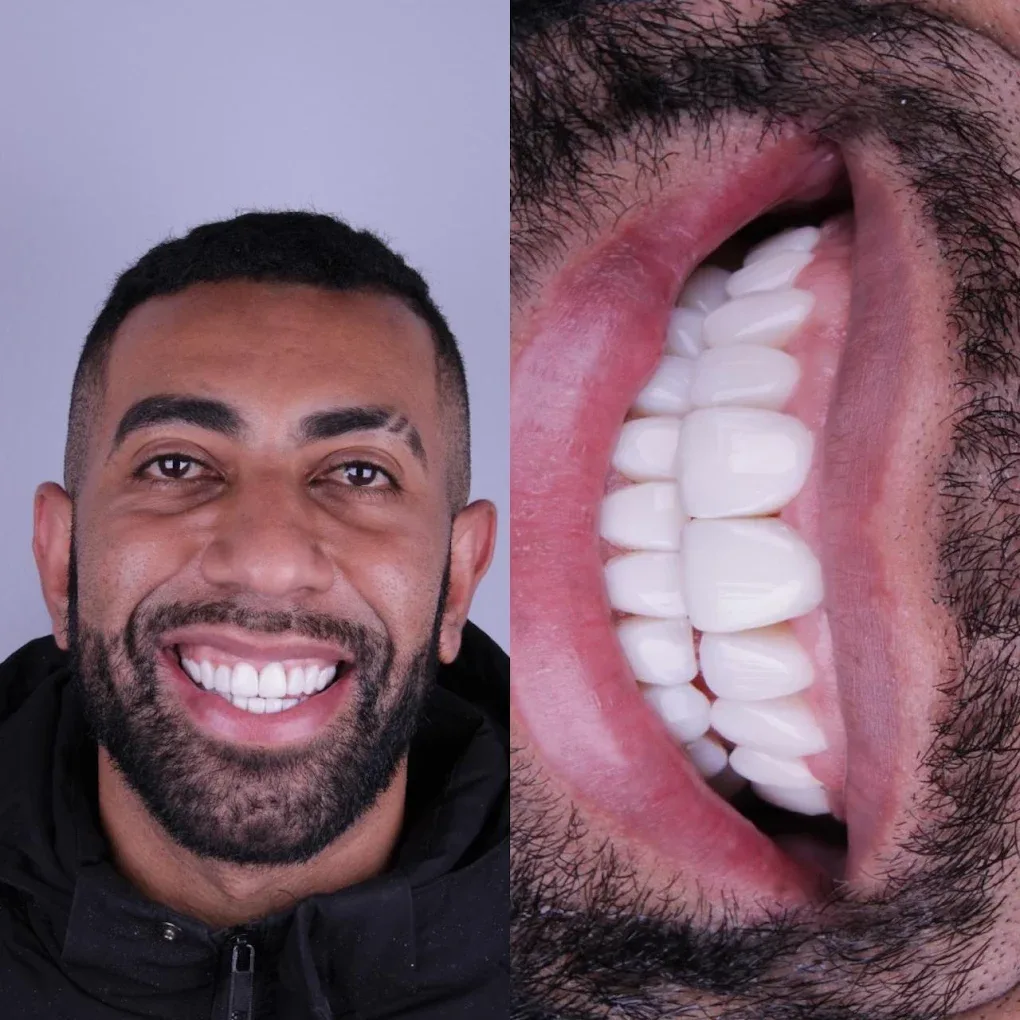 Lentes de contato dental, antes e depois