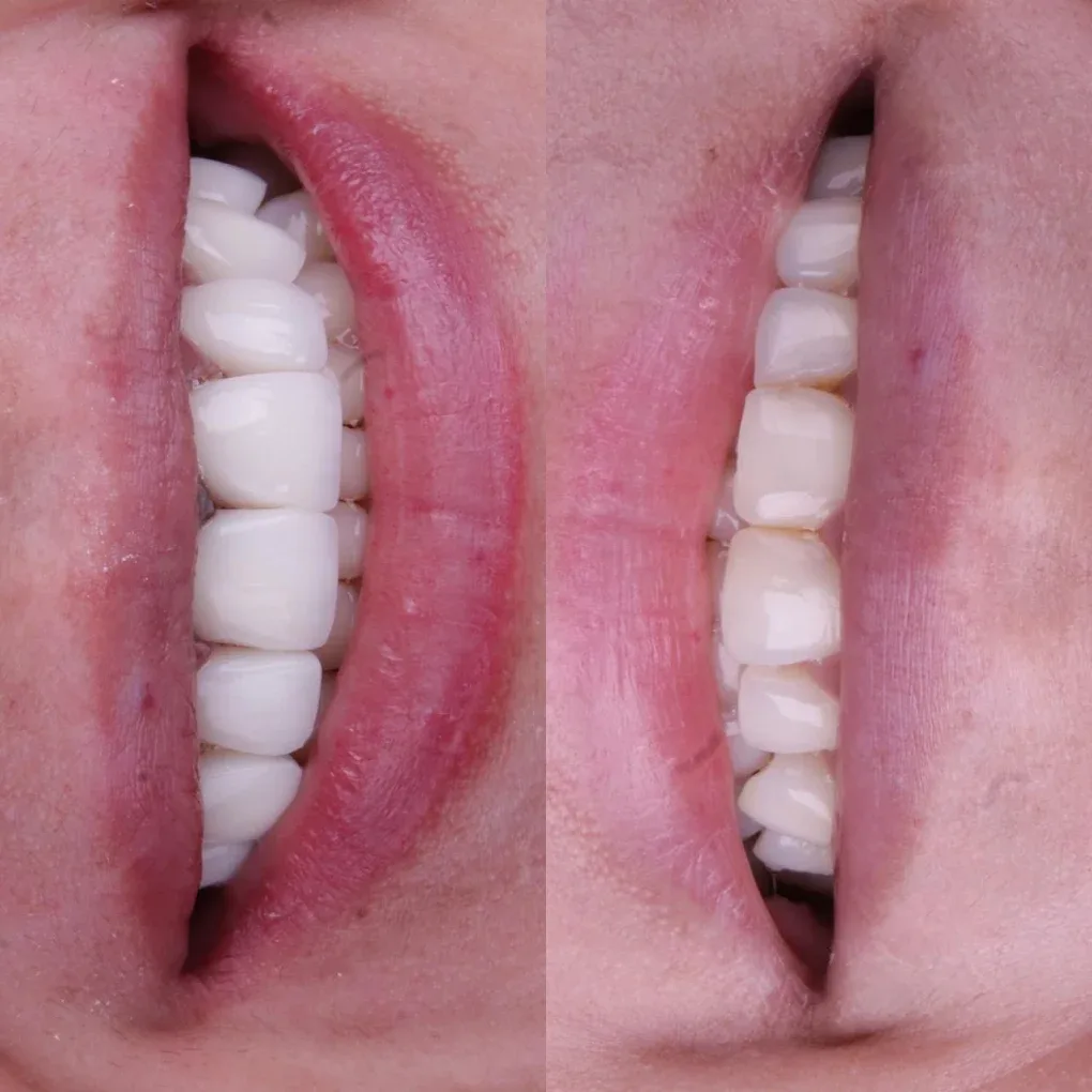 Lentes de contato dental, antes e depois