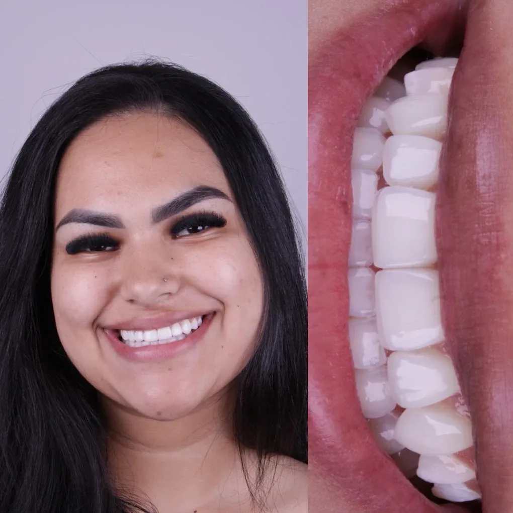 Lentes de contato dental, antes e depois