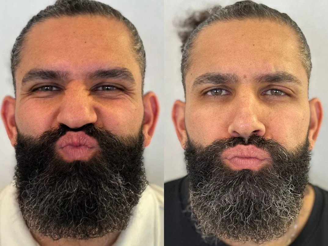 Toxina no masseter, antes e depois