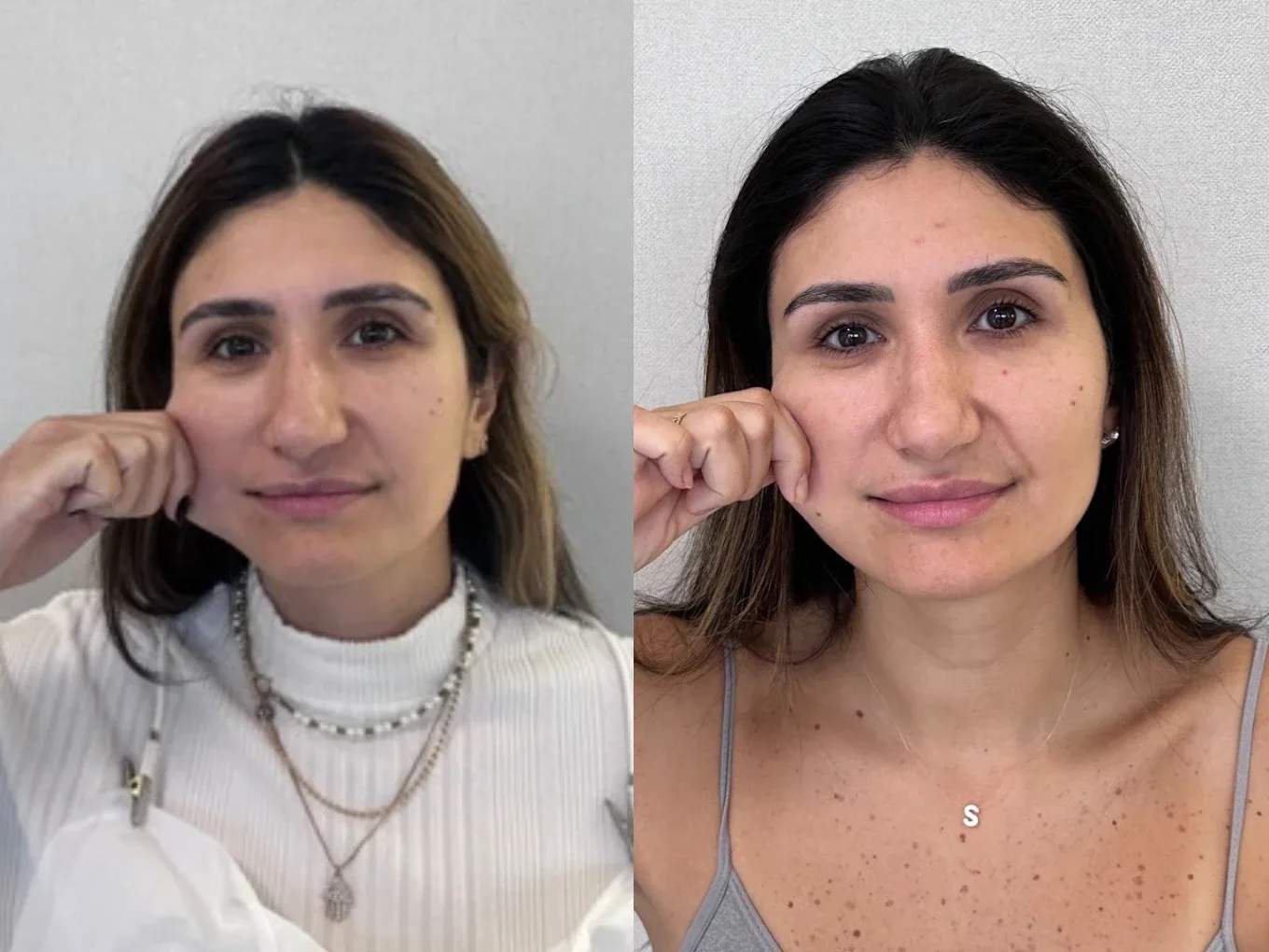 Olheiras, antes e depois