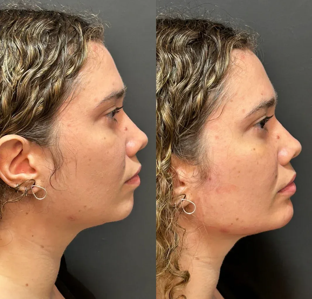 Preenchimento facial