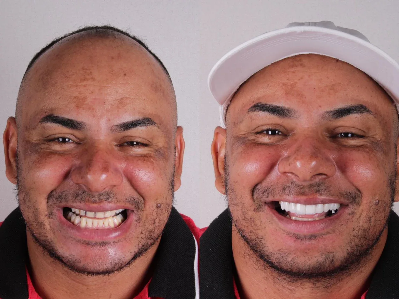 Clareamento dental
