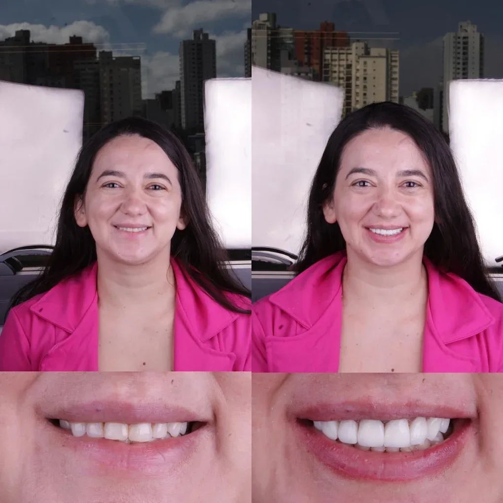 Alinhadores invisíveis